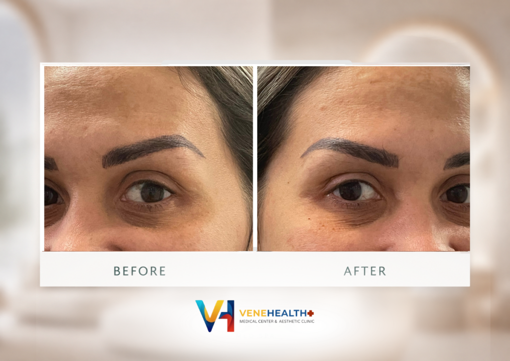 wrinkles-botox-venehealth