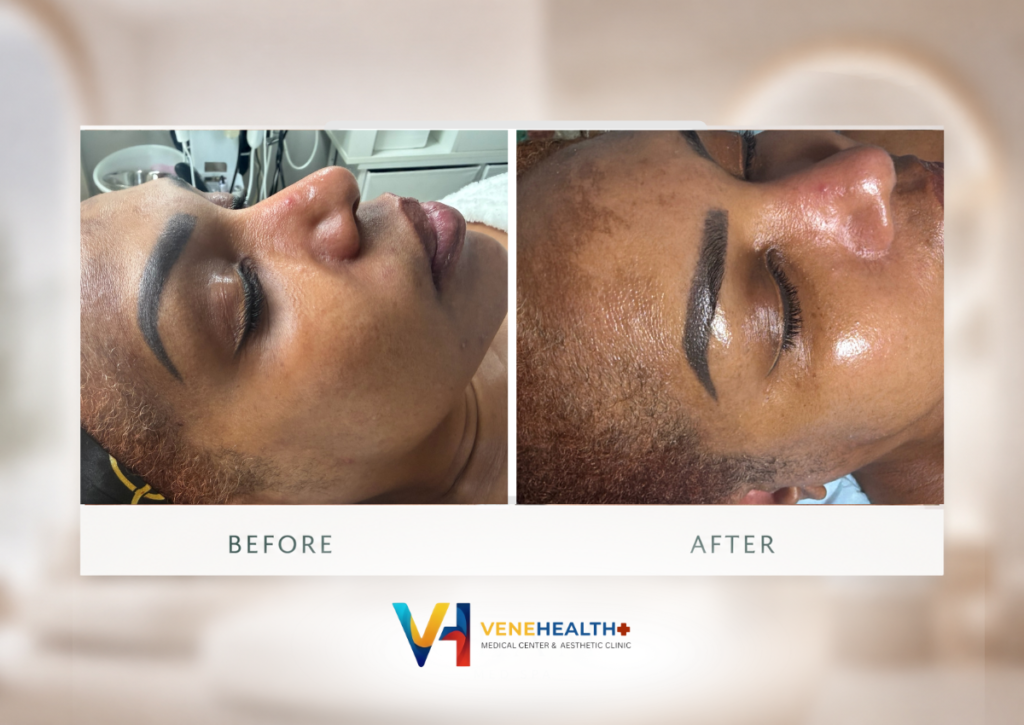 hydrafacial-venehealth